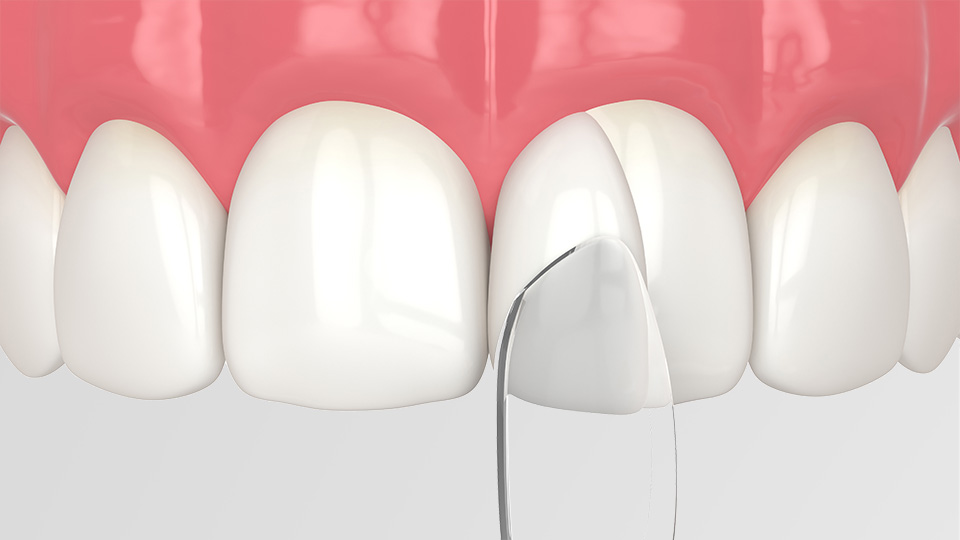 Dental Bonding Dentist Near Me